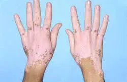 vitiligo kezelés