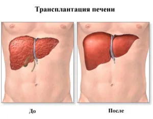 Лечение на рак на черния дроб народни средства, химиотерапия, наркотици, chemoembolization и биохимия