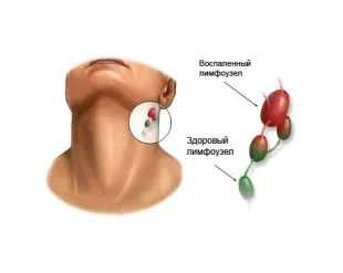 vaselor limfatice si noduri inflamație konechnosi structura de jos și a bolii
