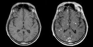 Mágneses rezonancia képalkotás az agy arról tanúskodnak, hogy a MRI, milyen gyakran lehet csinálni