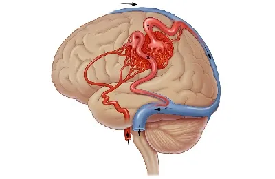 Малформация на мозъчните съдове признаци, симптоми и лечение