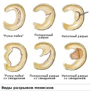 на коляното Meniskopatiya лечение на народната медицина, лечение на народната медицина