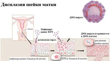 Методи за лечение на дисплазия radiowave, хирургически или оперативно лазерни действие пациент