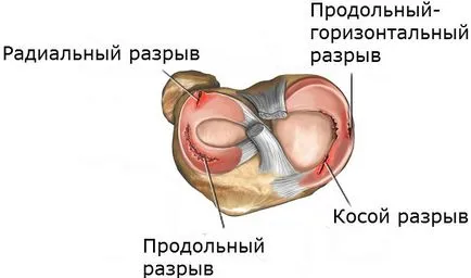 Meniskopatiya коляното лечение ставни заболявания