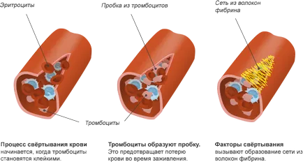 Нарушения в кръвосъсирването - причини за симптомите, методите за лечение