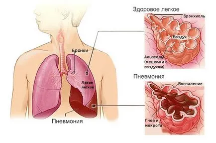 Bronchopneumoniát (lobularis tüdőgyulladás) gyermekek tünetei és kezelése