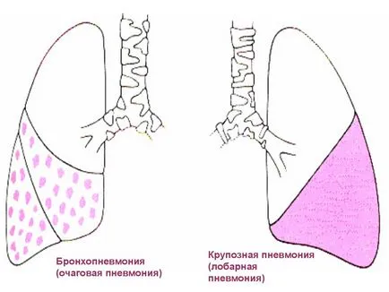 Бронхопневмония (лобуларен пневмония) в детските симптоми и лечение