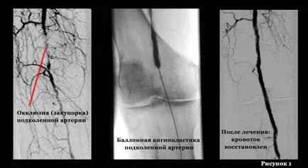 Атеросклероза съдове и артериите на долните крайници - експлоатация третиране