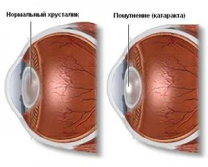 Хирургия на мястото на обектива на следоперативния период