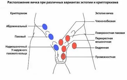 Операция с крипторхизъм и последствия след това