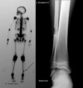 Osteom provoaca osul, simptomele, tratamentul osteom al frontal, occipital, tibia, femurul