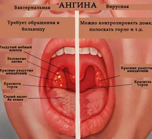 Остра заразна болест