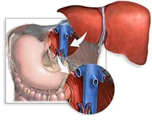 transplant de ficat