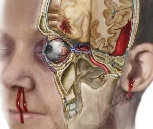 Fractura a simptomelor de baza craniului, diagnostic, tratament, consecințele