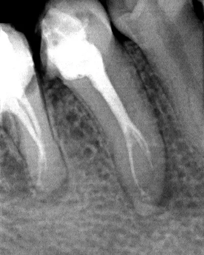 Periodontita, acute, cronice, agravarea