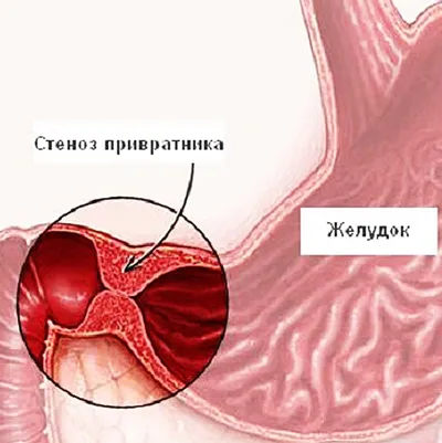 Pylorus stenosis diagnózisa, kezelése, a tünetek, okok