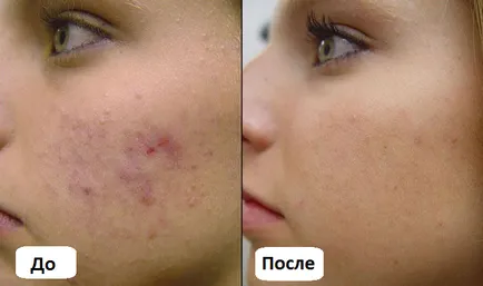 Peeling főzeteket otthon hidrogén-peroxiddal előtti és utáni képek, beszámolók