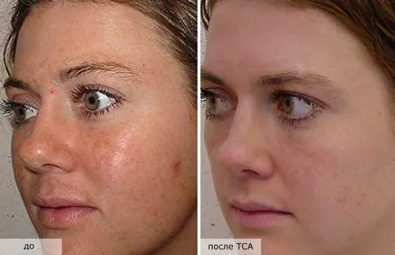 Peeling TCA feței ca mediu se realizează, chimice, efect peeling galben de zi, pielea după