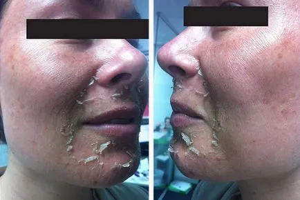 Peeling TCA feței ca mediu se realizează, chimice, efect peeling galben de zi, pielea după