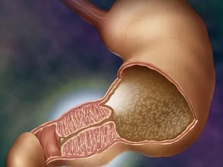 Pylorus stenosis diagnózisa, kezelése, a tünetek, okok