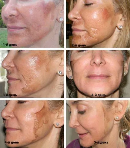 ТСА пилинг лицето като се провежда среда, химически пилинг жълто ефект от ден, кожата след