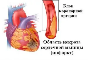 Последствията от масиран инфаркт, и проявява