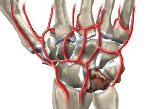 Cauzele și tratamentul osteonecroză a osului semilunaro (boala lui Kienbock)