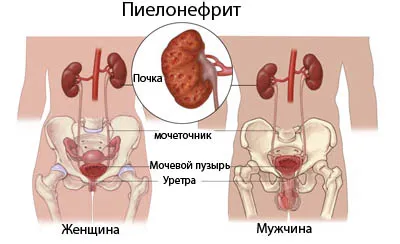 Причини за възникване на пиелонефрит и тригери