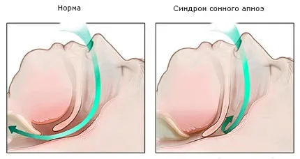 Припадъци спре дишането описание на симптоми, лечение, причини