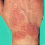 eczema ocupațională - cauze, simptome, diagnostic și tratament