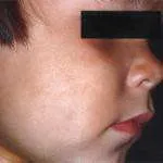 Simplu alb tratament impetigo, simptomele, cauzele, prevenirea, fotografii