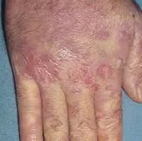 eczema ocupațională - cauze, simptome, diagnostic și tratament