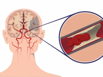 Mennyire veszélyes ischaemiás stroke, a szakértő hölgy