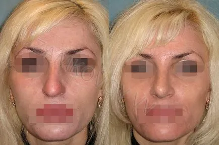 Columela rinoplastie, Columella din plastic