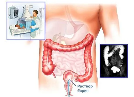 intestinului cu raze X cu bariu - în special a