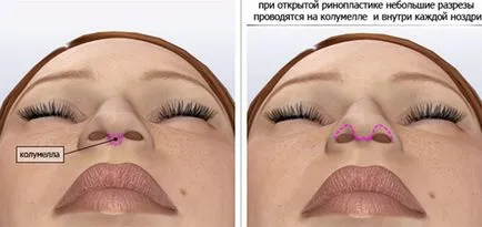 Rinoplastia (operația nasului) - ce este, înainte și după fotografii, comentarii, pret