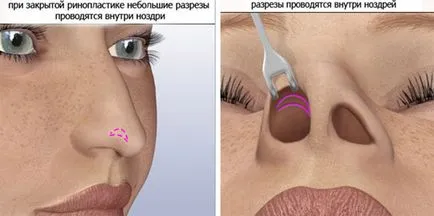 Rinoplastia (operația nasului) - ce este, înainte și după fotografii, comentarii, pret