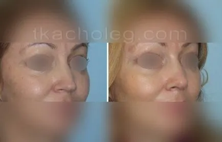 Columela rinoplastie, Columella din plastic