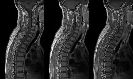 Spinalis muscularis amiotrófia Verdniga-Hoffmann okoz, a tünetek, a kezelés