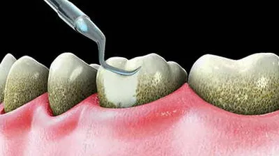 Миенето на зъбите за това как пречистването камък, особено процедура - около хапят корекция и