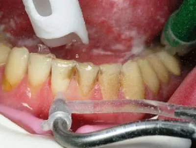 Миенето на зъбите за това как пречистването камък, особено процедура - около хапят корекция и