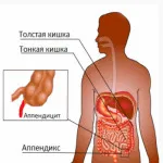 Temperatura după rata apendicectomie sau complicând