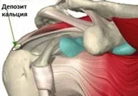 Tendinita de umar in comun - cauze, simptome, diagnostic și tratament