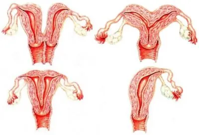 tonusul uterului în timpul sarcinii simptome în primul trimestru, simptomele și cauzele stadiile incipiente,