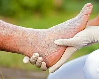 Thrombophlebitis az alsó végtagok, mi az, kezelés