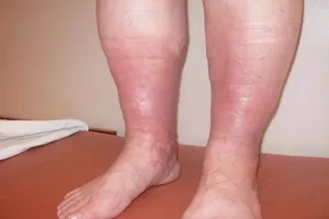 Thrombophlebitis és tromboembólia kép, diagnózis, kezelés, torna és a megelőzés