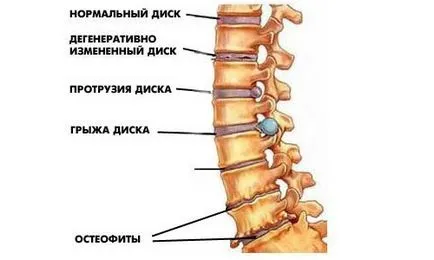 Симулатор за разтягане и разтягане на гърба и гръбначния стълб видове, показания, противопоказания,