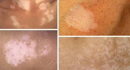 Tratamentul Vitiligo simptome foto care aceasta boala, cauzele