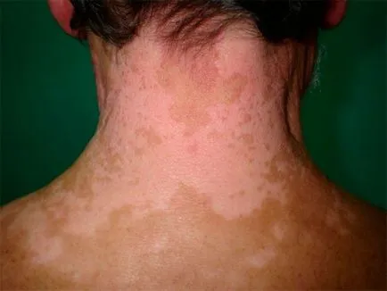 Vitiligo kezelésében fotó tünetek, hogy ez a betegség okai