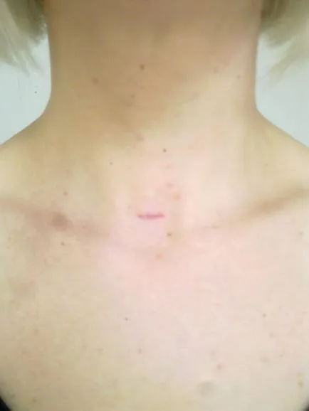 tiroidă îndepărtarea Videoassisted (mivat) - clinica Catherine